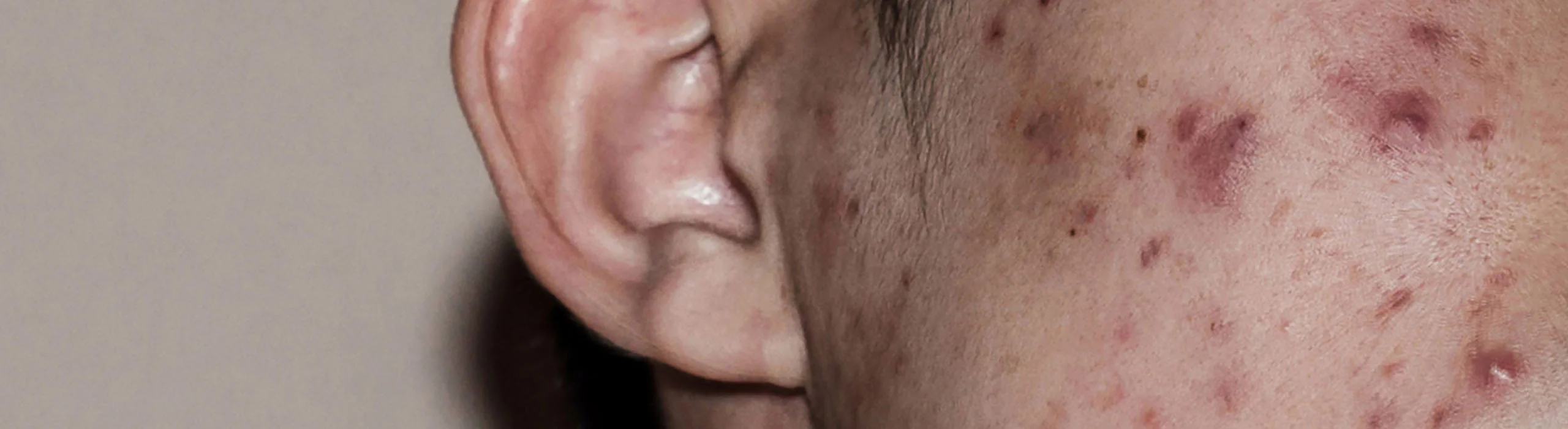 Doctor-led acne and rosacea assessment at Rejuvena Clinic, Bedford
