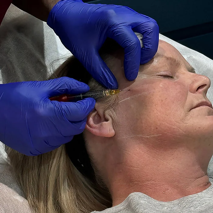 Doctor-led dermal filler assessment for marionette lines at Rejuvena Clinic, Bedford
