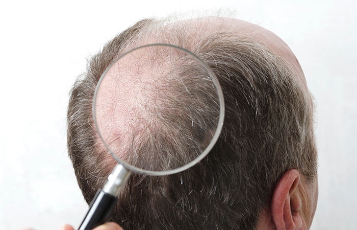 hair loss prp treatment