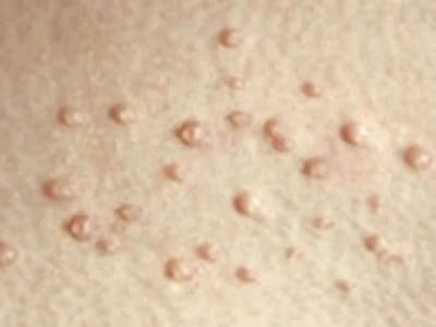 Close clinical photograph of molluscum contagiosum papules
