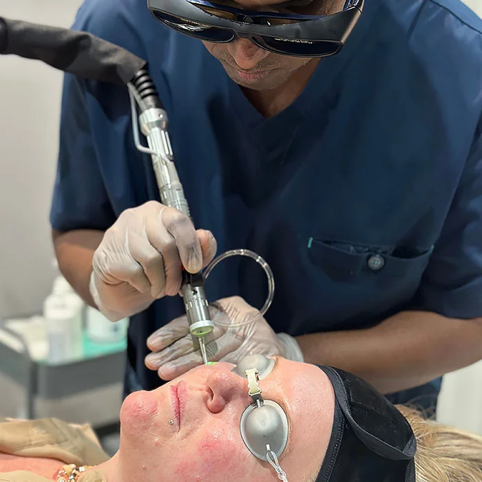 Doctor-led thread vein assessment at Rejuvena Clinic, Bedford