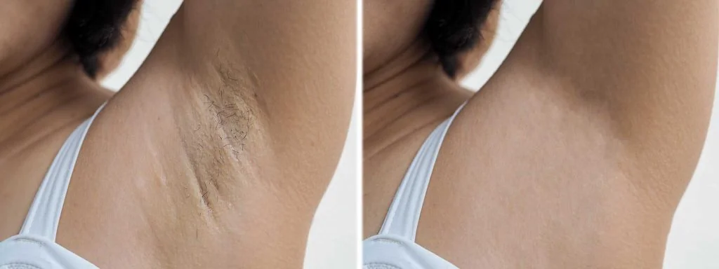 before and after laser hair removal