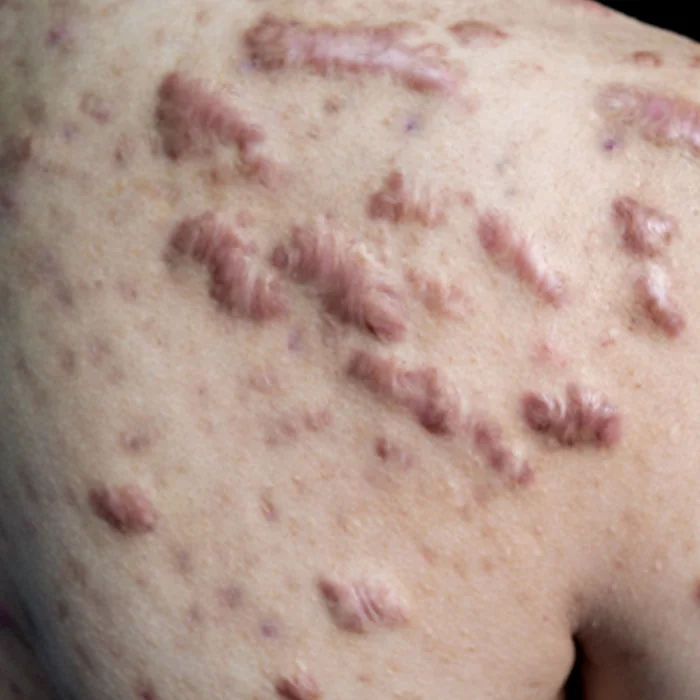Doctor-led keloid scar assessment at Rejuvena Clinic, Bedford
