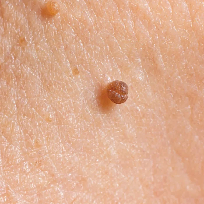 Close clinical photograph of multiple skin tags