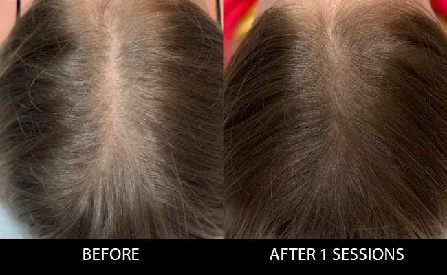prp treatment for hair loss