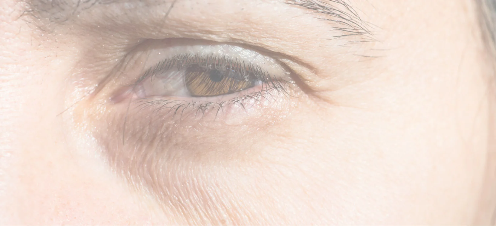 Doctor-led tear trough assessment at Rejuvena Clinic, Bedford