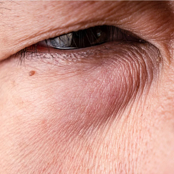 Doctor-led eye bag and tear trough assessment at Rejuvena Clinic, Bedford