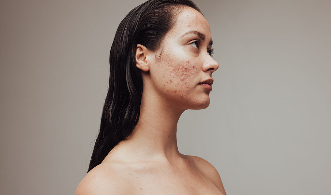 Effective acne treatments Bedford