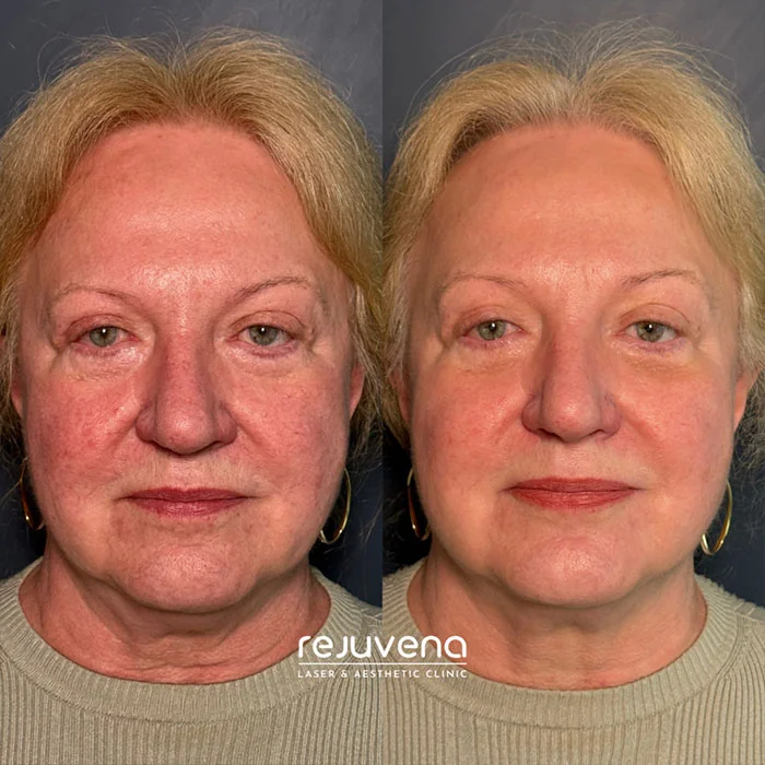 rosacea treatment images