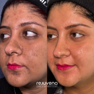 cosmelan peel treatment