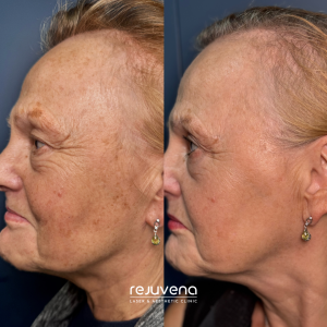 lumecca IPL treatment