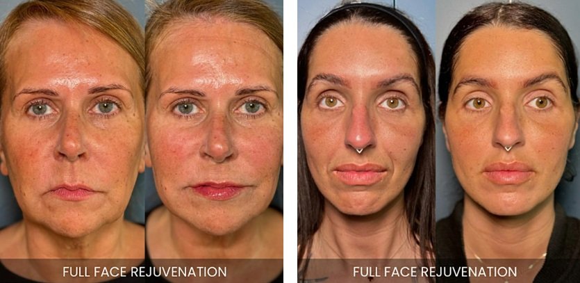 before-after img1