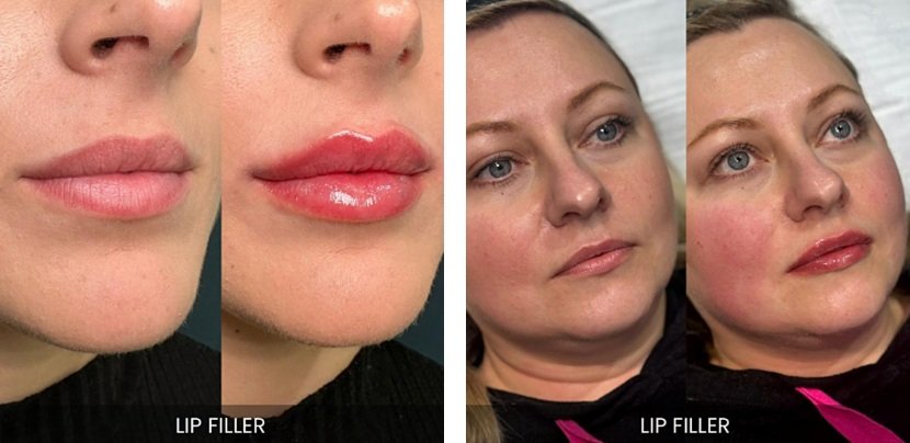 before-after img2