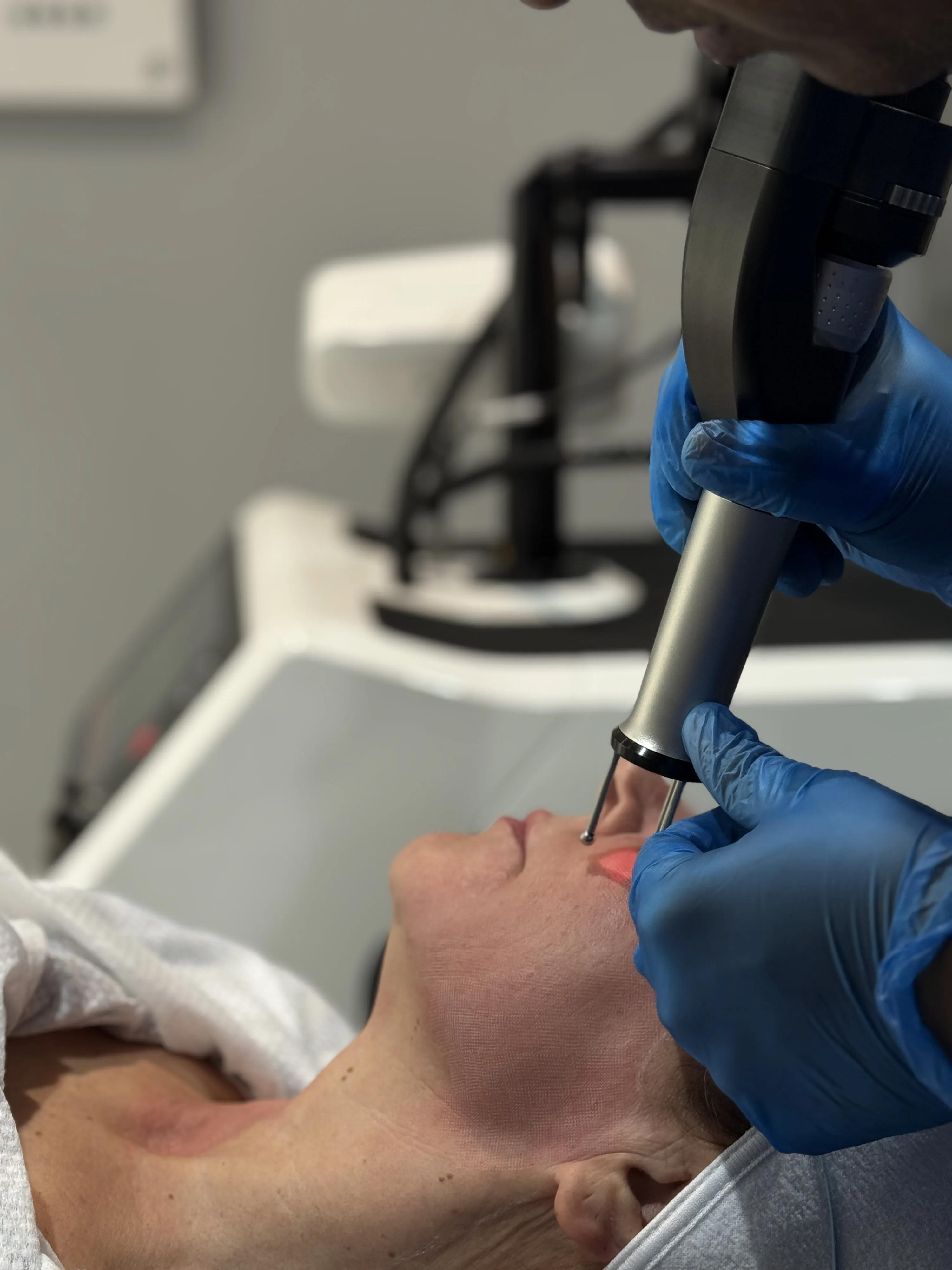 Dermablate Cool Laser Er:YAG handpiece used to debulk thick verruca callus at Rejuvena Clinic, Bedford