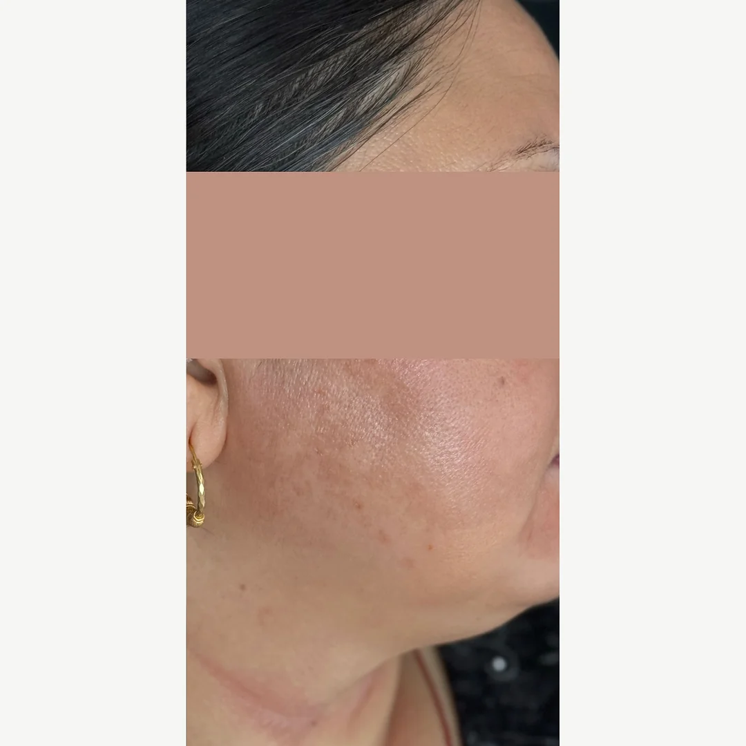 Cheek melasma after — Cosmelan depigmentation — Rejuvena Clinic Bedford