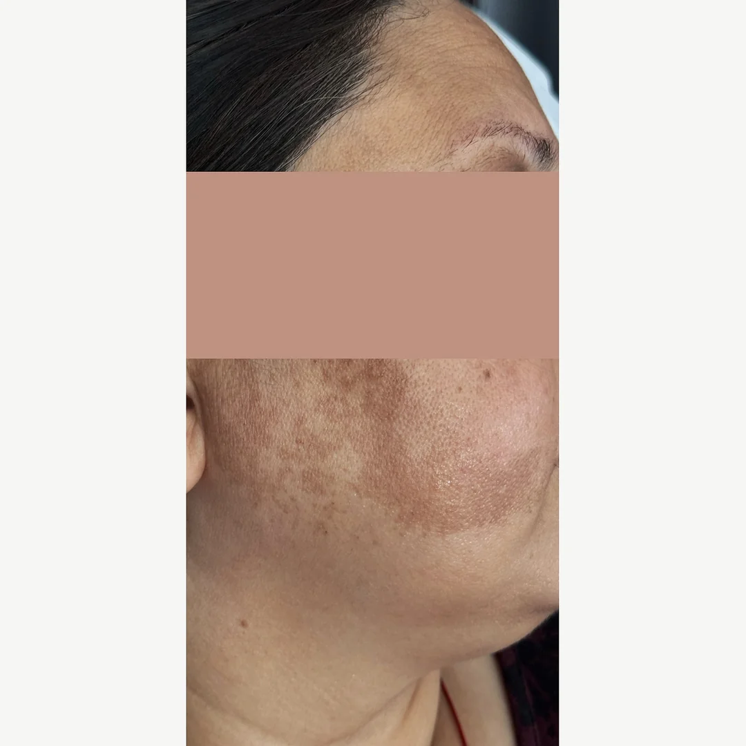 Cheek melasma before — Cosmelan depigmentation — Rejuvena Clinic Bedford