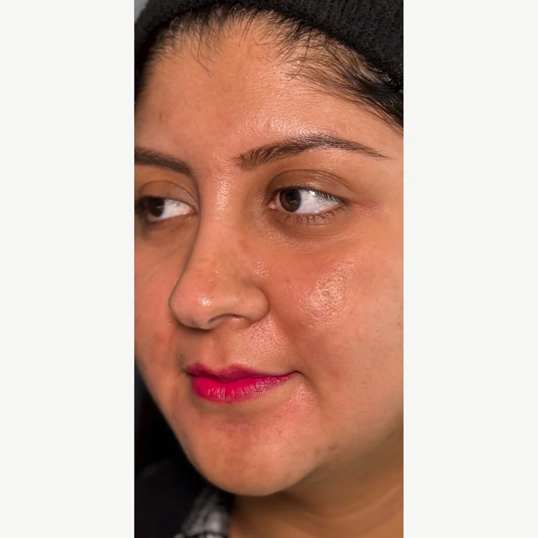 Pigmentation after — Lumecca IPL photofacial — Rejuvena Clinic Bedford