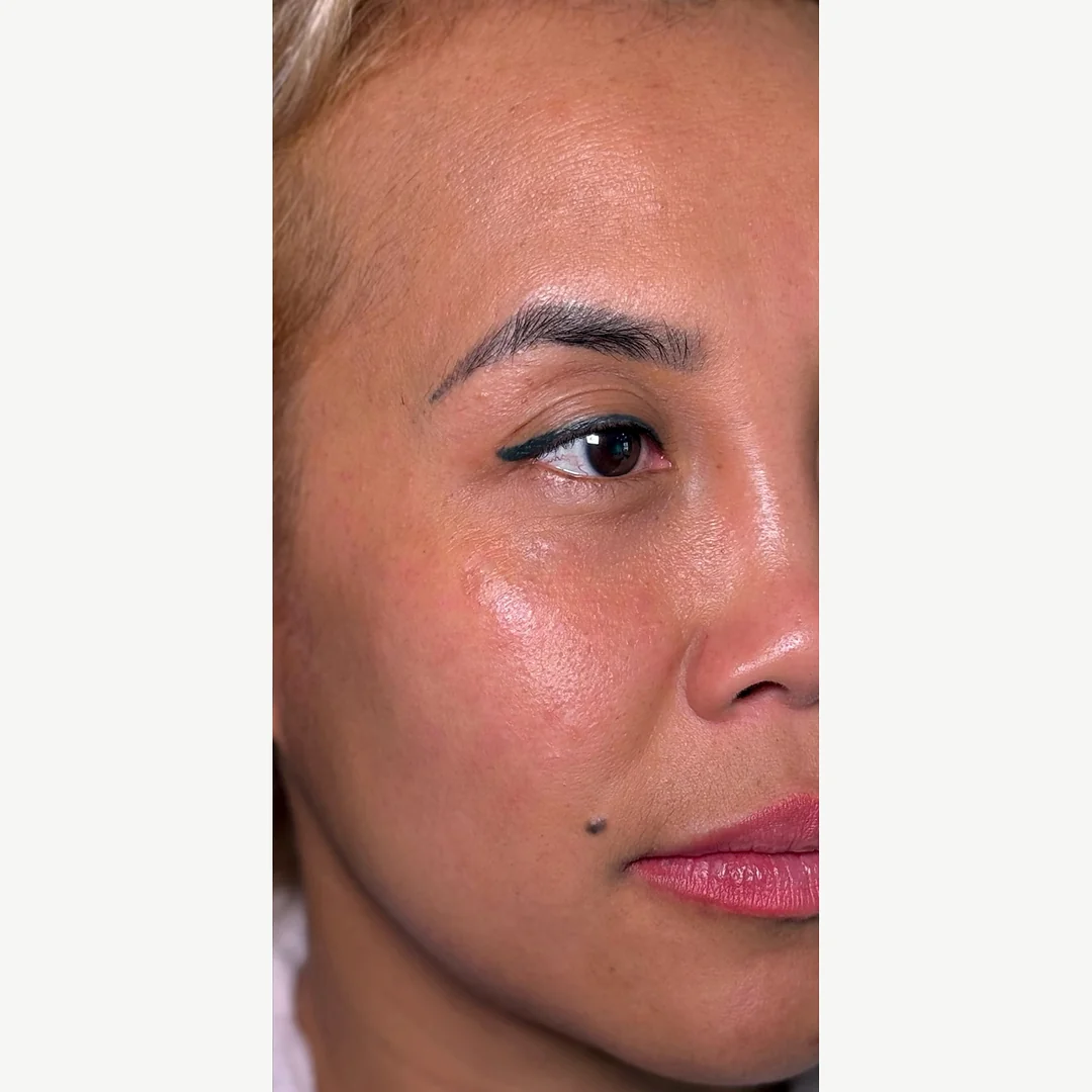 Dermatosis papulosa nigra after — DPN removal — Rejuvena Clinic Bedford