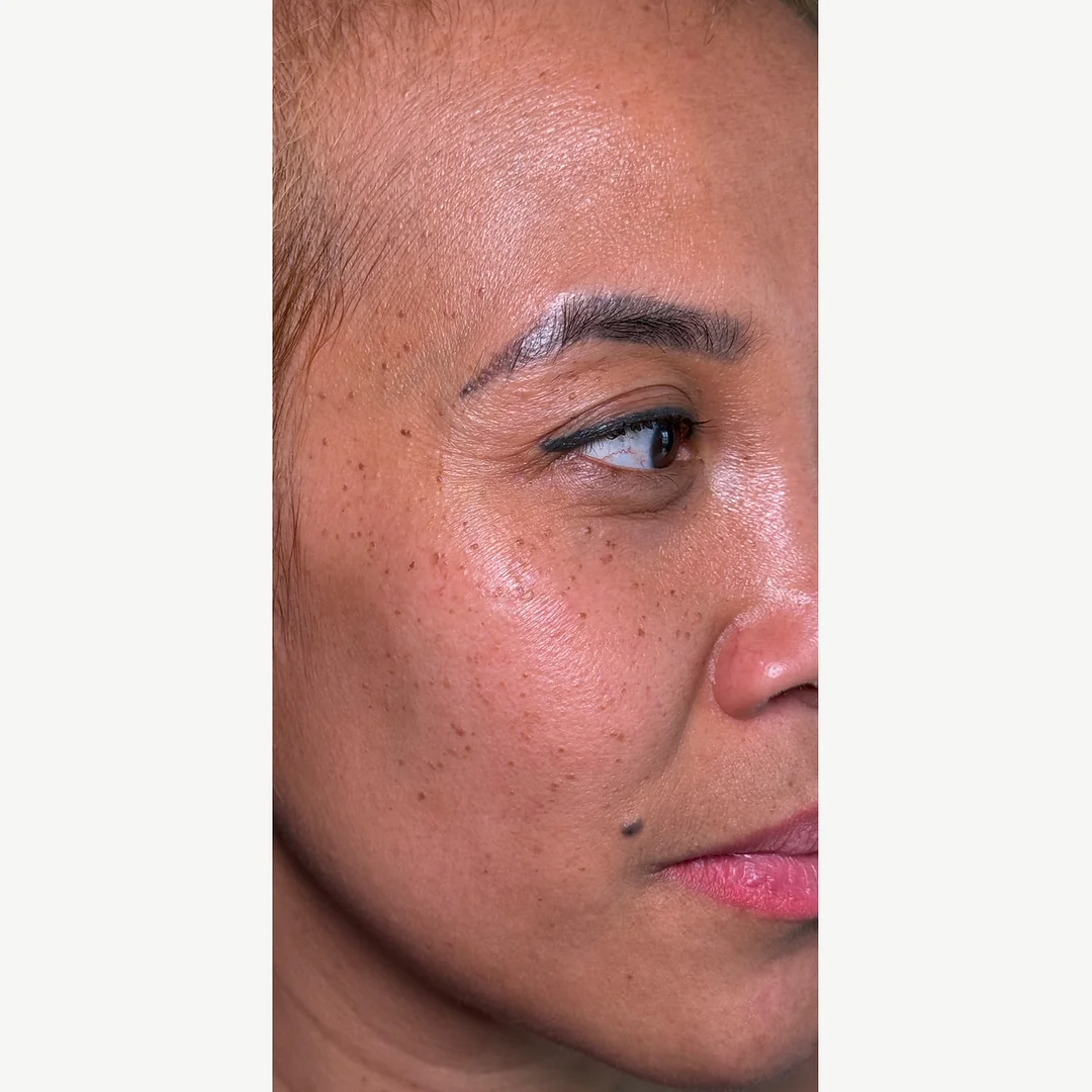Dermatosis papulosa nigra before — DPN removal — Rejuvena Clinic Bedford