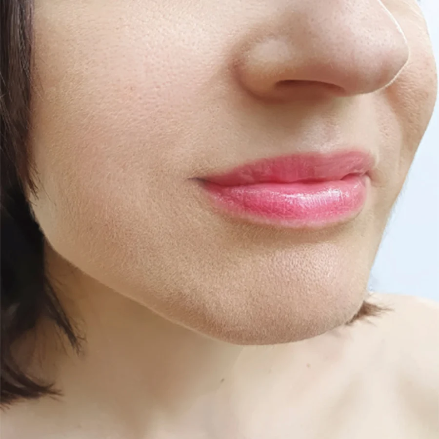 Lower face and jawline after Forma skin tightening at Rejuvena Clinic Bedford