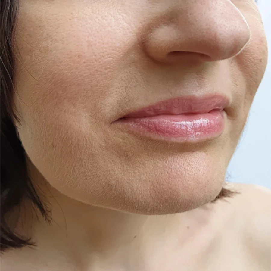 Lower face and jawline before Forma skin tightening at Rejuvena Clinic Bedford