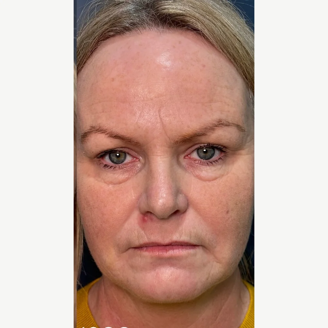 Facial skin after — skin rejuvenation — Rejuvena Clinic Bedford