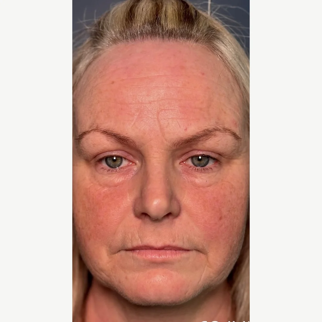 Facial skin before — skin rejuvenation — Rejuvena Clinic Bedford