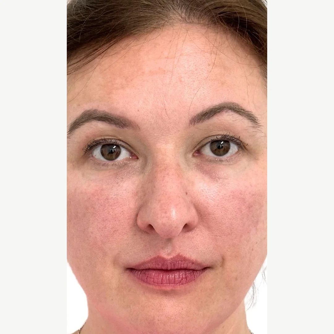 Complexion after — skin rejuvenation — Rejuvena Clinic Bedford