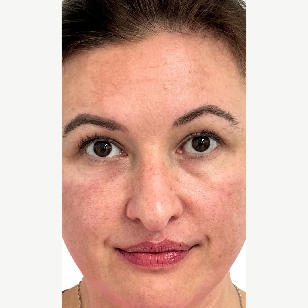 Complexion before — skin rejuvenation — Rejuvena Clinic Bedford