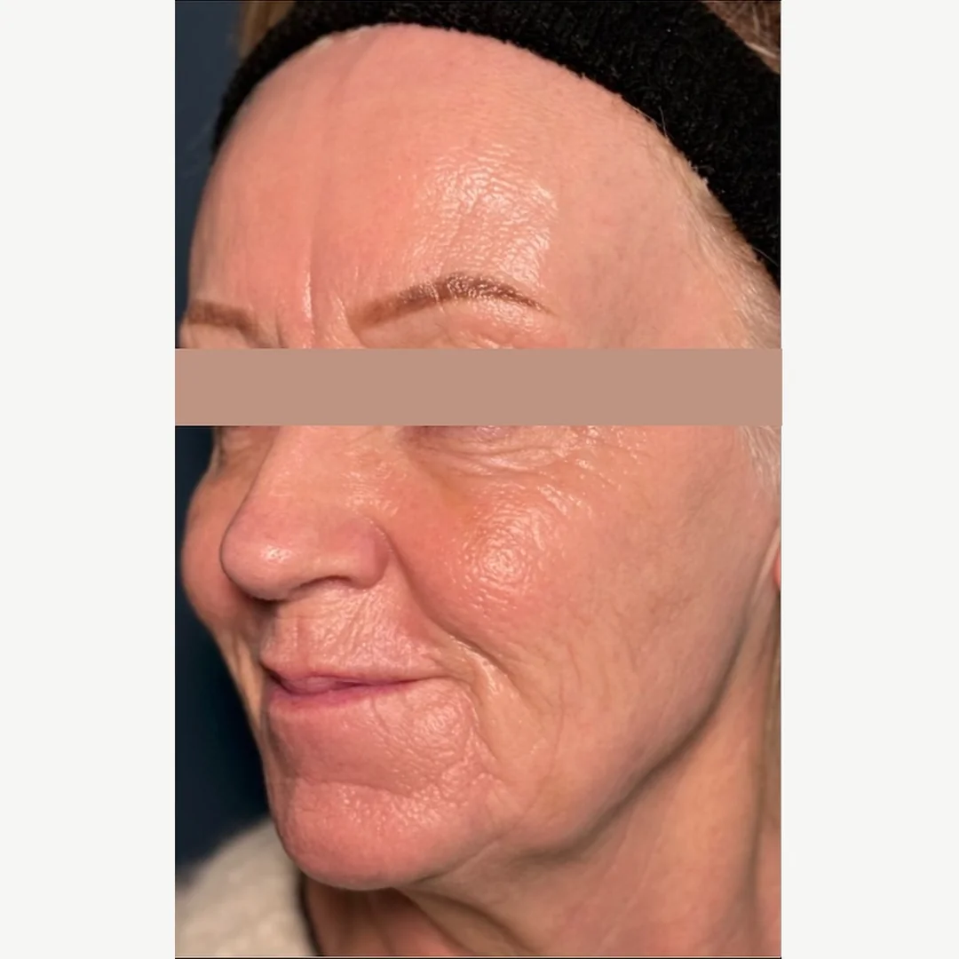 Skin rejuvenation after — skin rejuvenation — Rejuvena Clinic Bedford