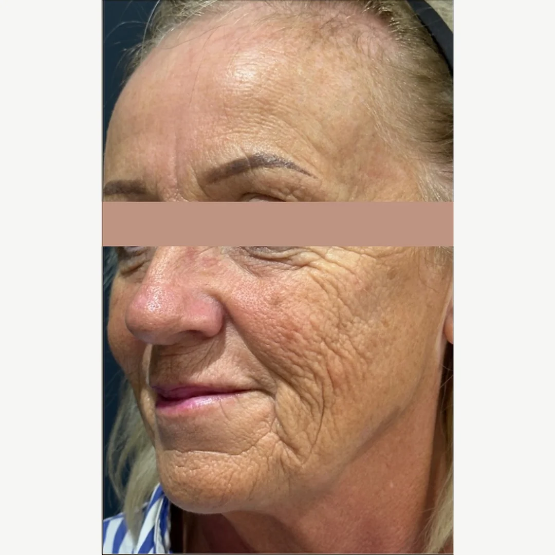 Skin rejuvenation before — skin rejuvenation — Rejuvena Clinic Bedford
