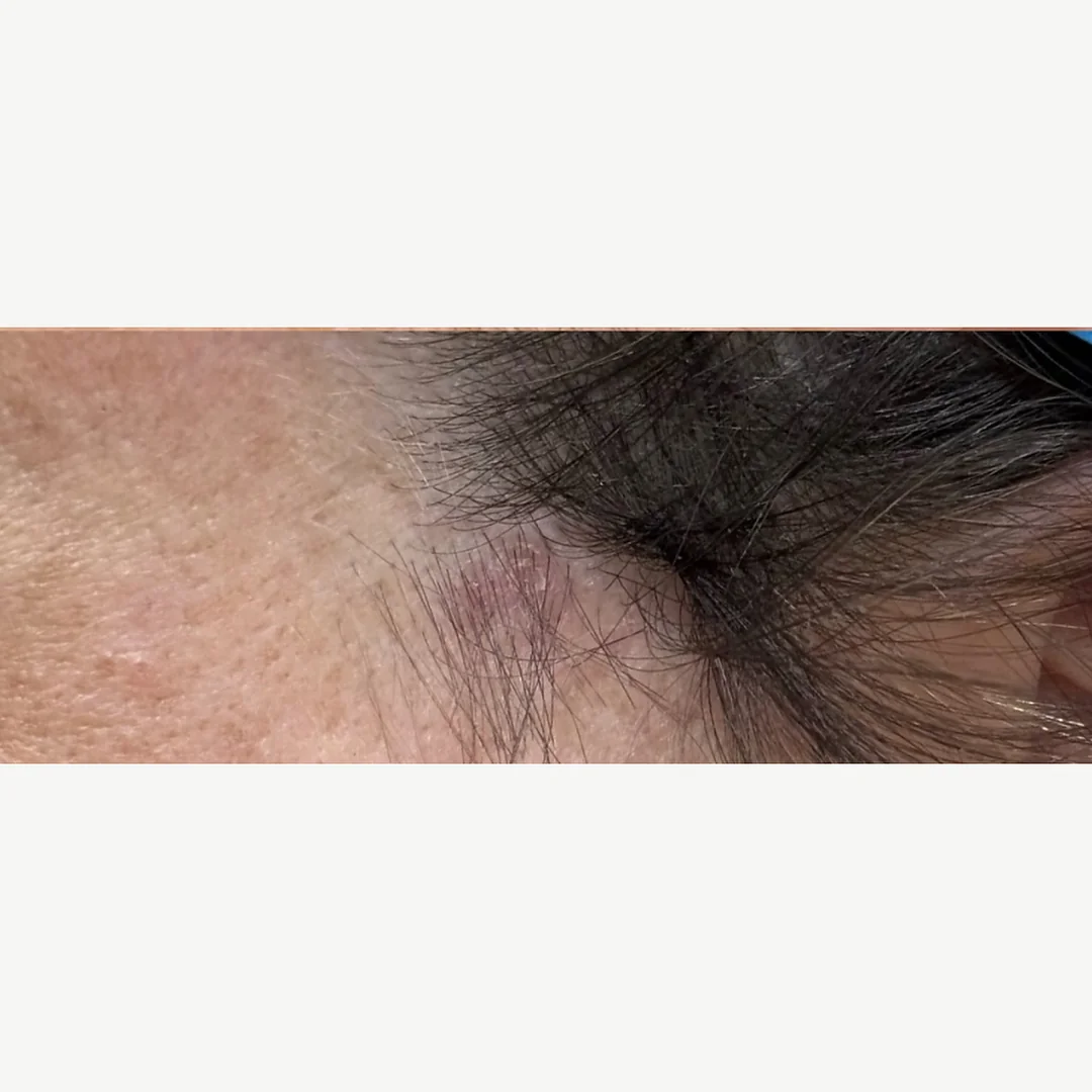 Neck lesion after — laser lesion removal — Rejuvena Clinic Bedford