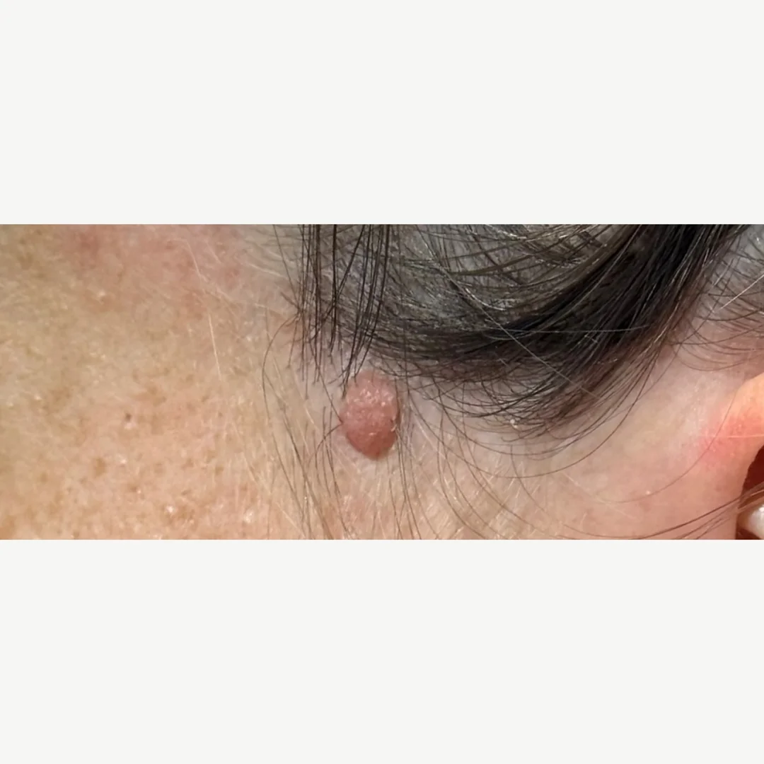 Neck lesion before — laser lesion removal — Rejuvena Clinic Bedford