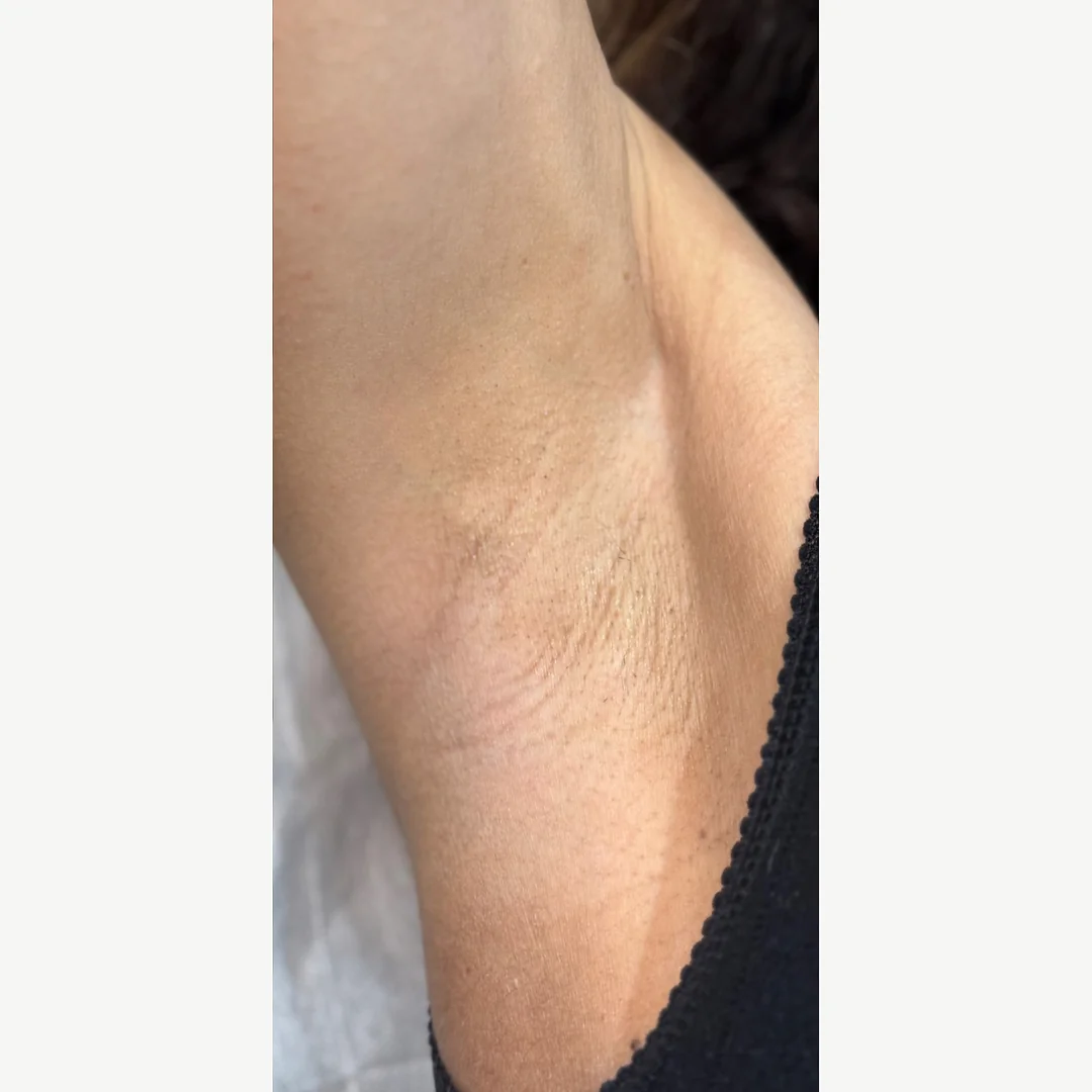 Underarm after — laser hair removal — Rejuvena Clinic Bedford