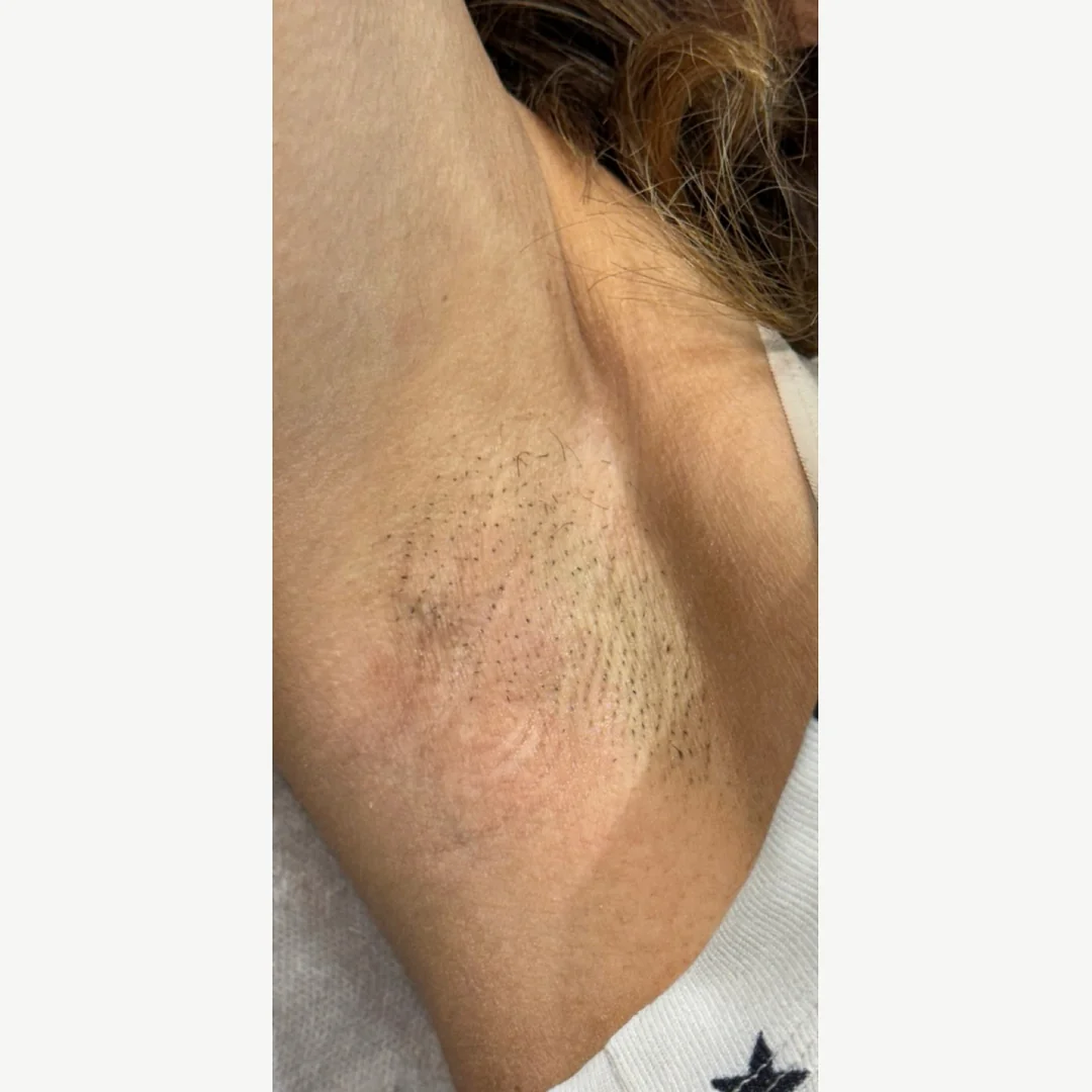 Underarm before — laser hair removal — Rejuvena Clinic Bedford