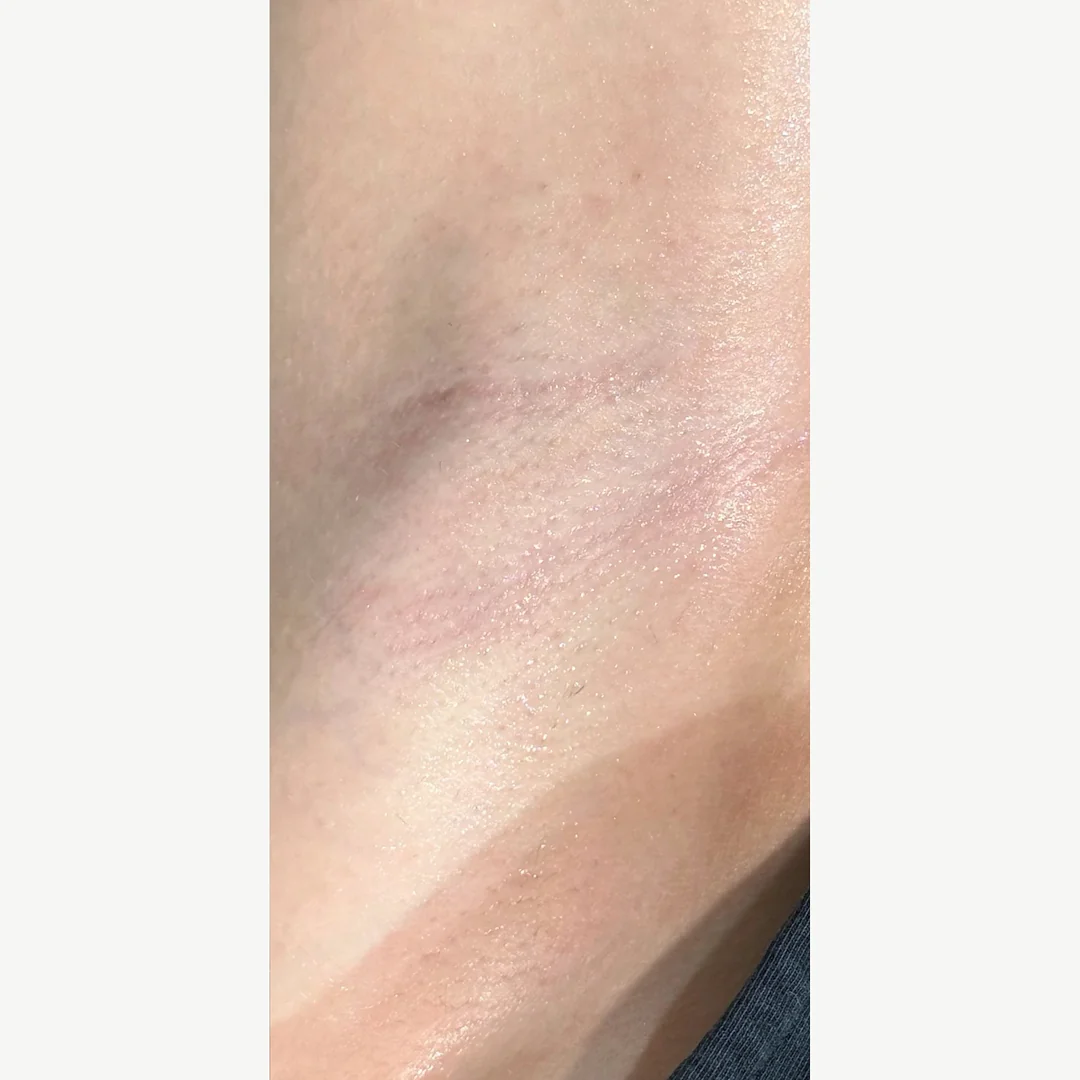Underarm (close) after — laser hair removal — Rejuvena Clinic Bedford