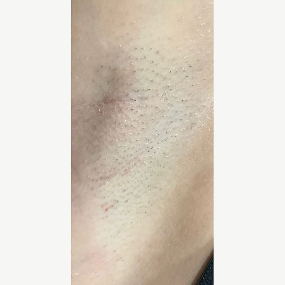 Underarm (close) before — laser hair removal — Rejuvena Clinic Bedford