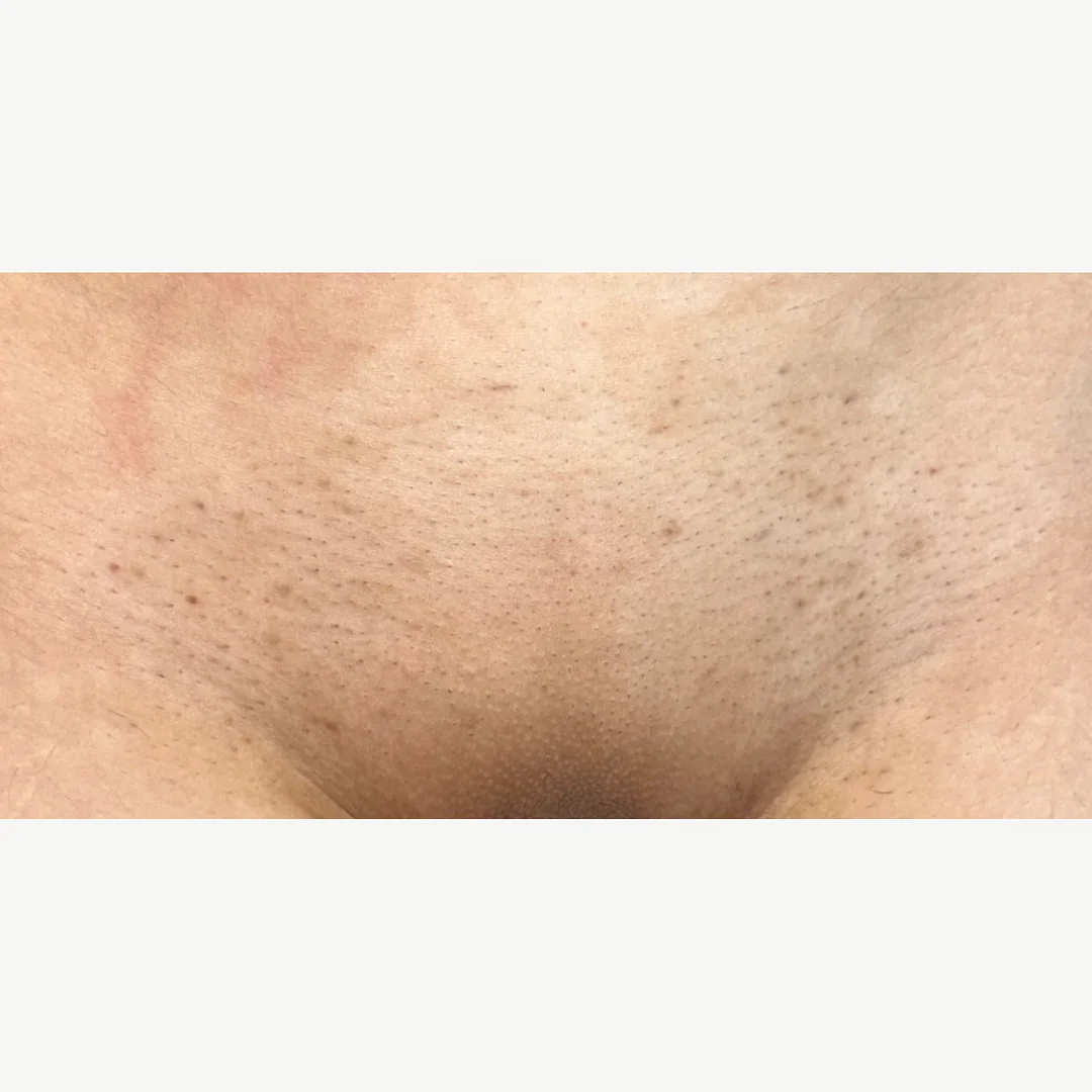 Treated area after — laser hair removal — Rejuvena Clinic Bedford