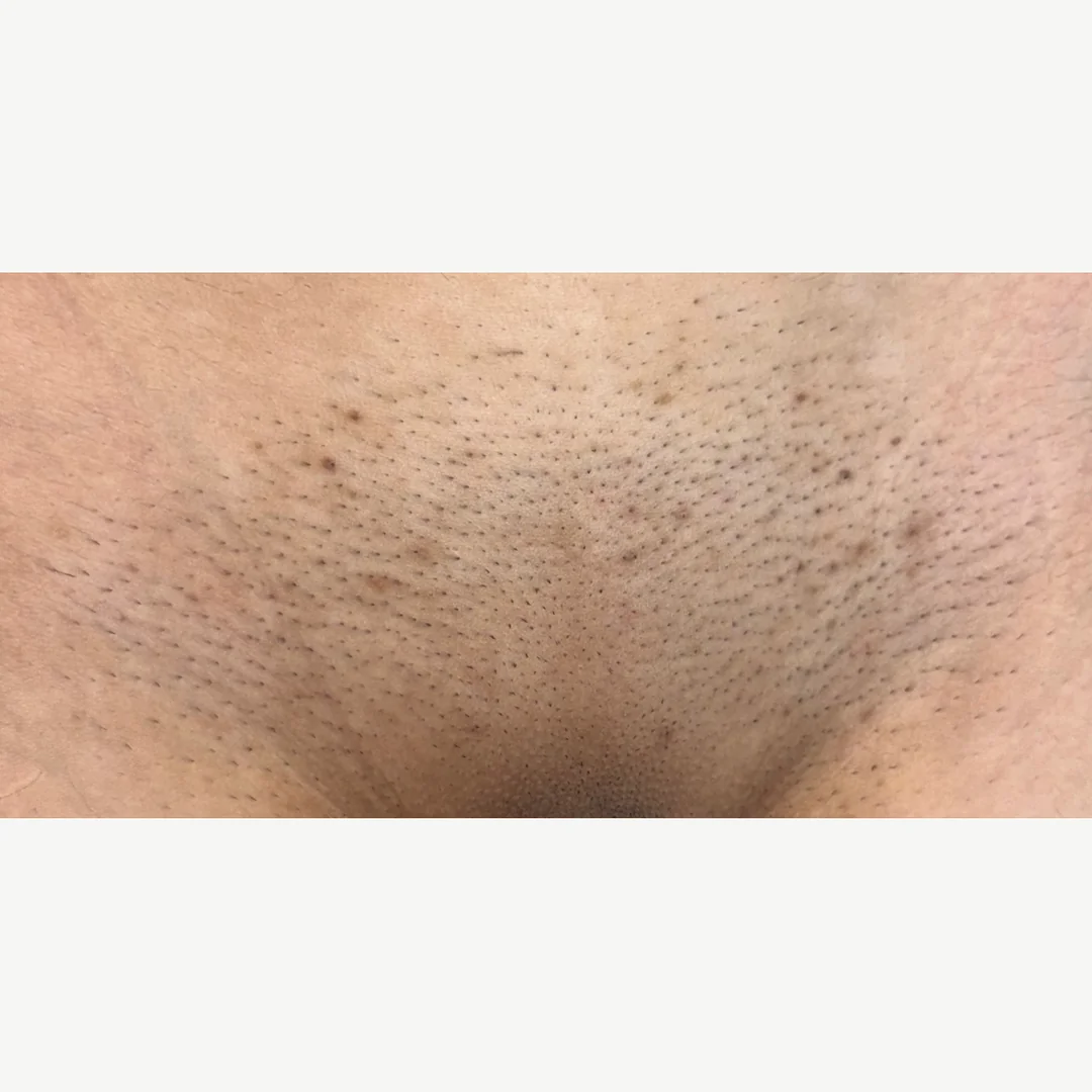 Treated area before — laser hair removal — Rejuvena Clinic Bedford