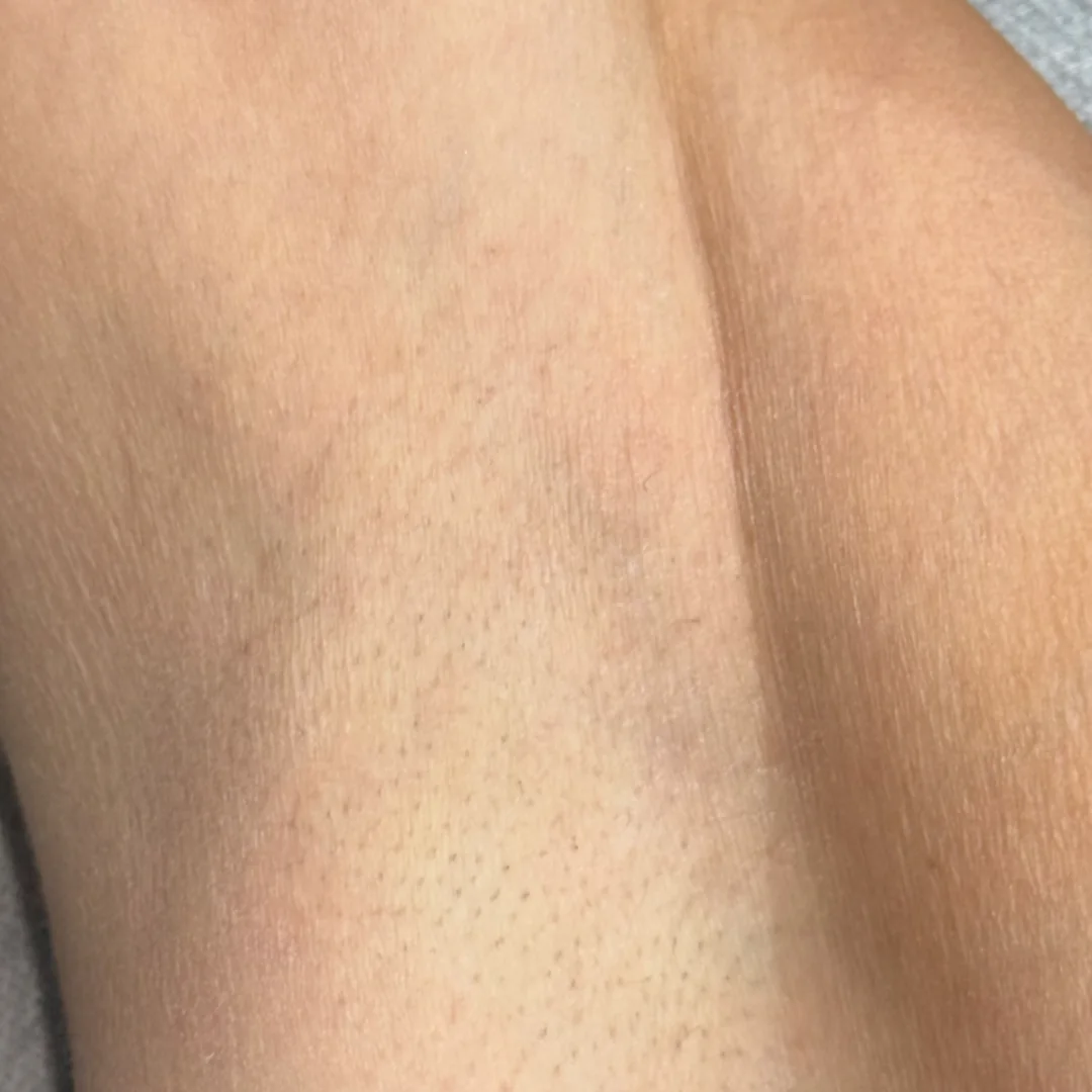 Underarm after — laser hair removal — Rejuvena Clinic Bedford