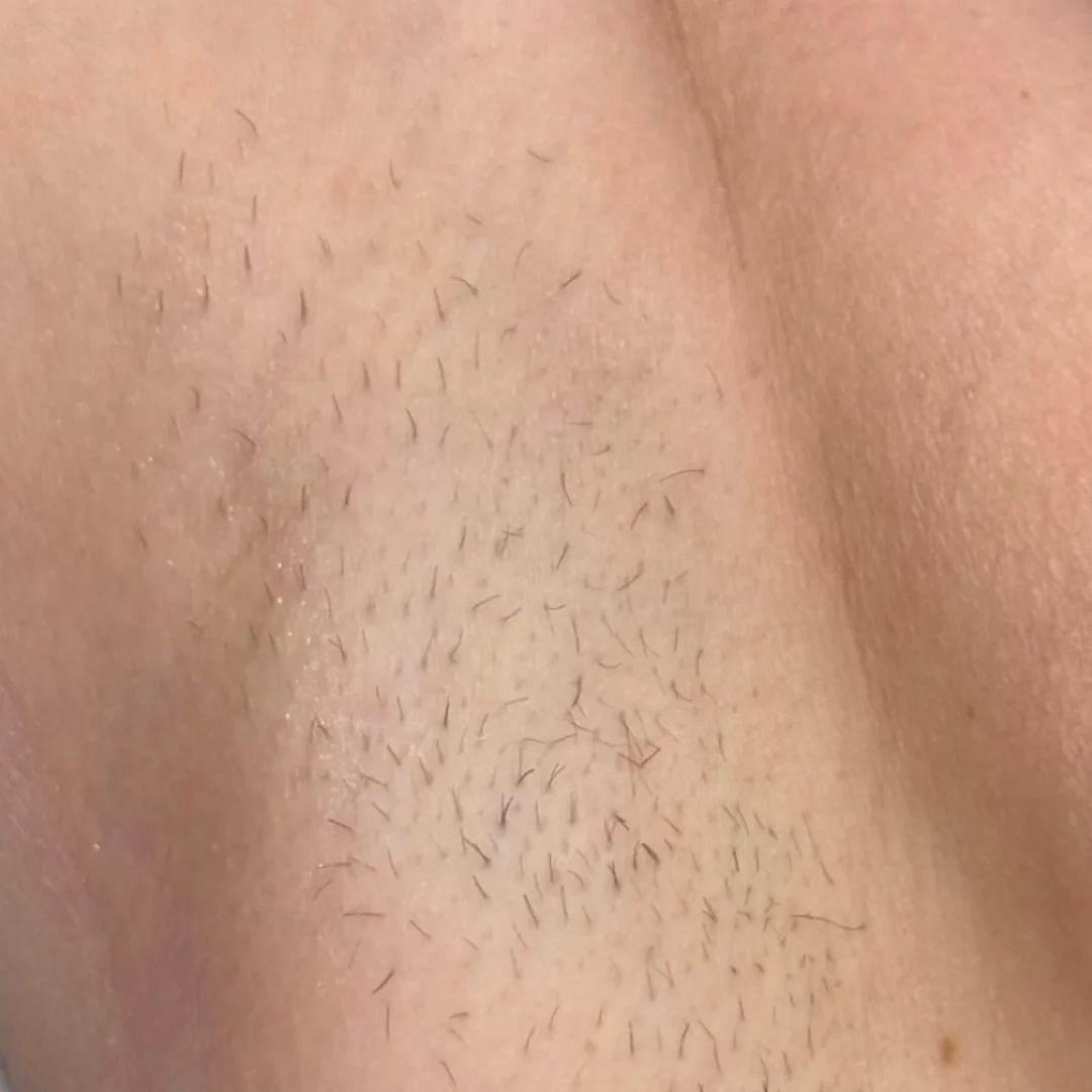 Underarm before — laser hair removal — Rejuvena Clinic Bedford