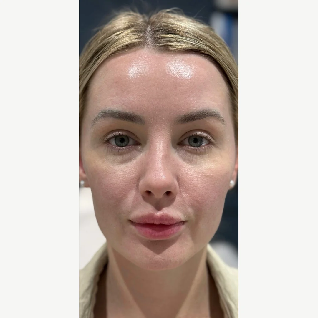 Freckles & redness after — Lumecca IPL photofacial — Rejuvena Clinic Bedford
