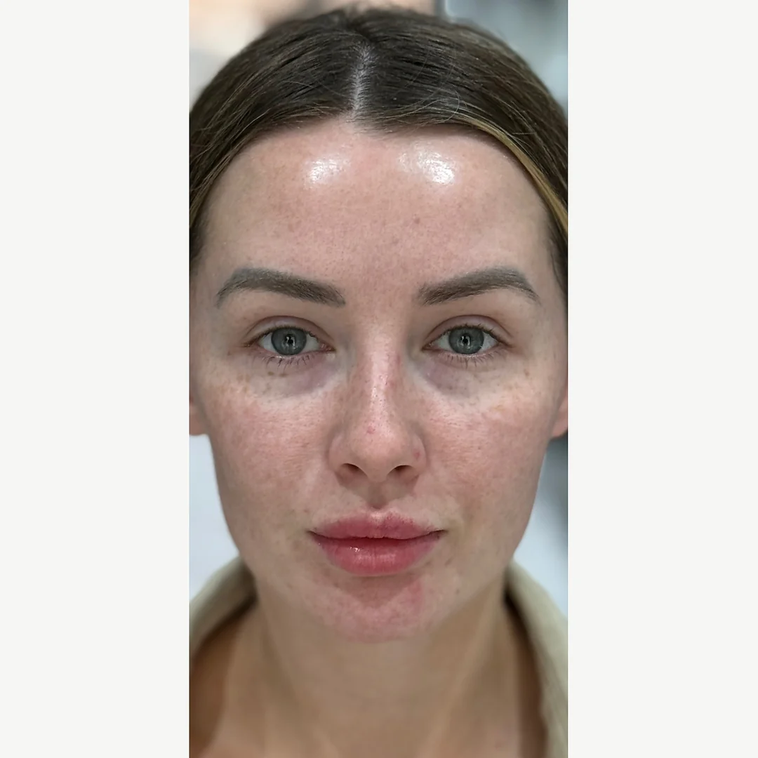 Freckles & redness before — Lumecca IPL photofacial — Rejuvena Clinic Bedford