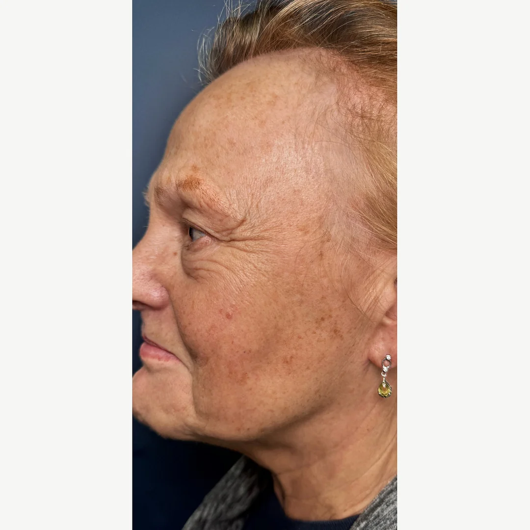 Age spots before — Lumecca IPL photofacial — Rejuvena Clinic Bedford