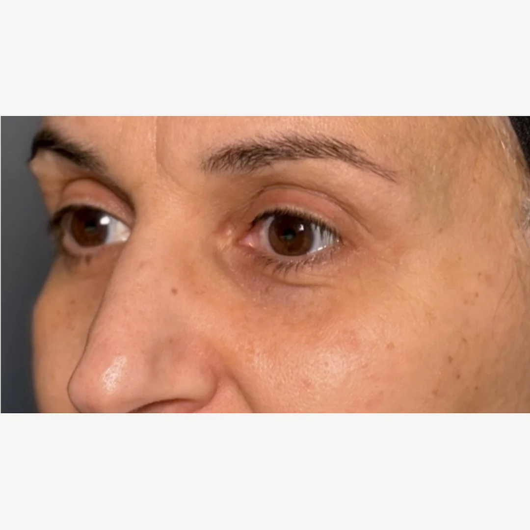 Under-eye after — Morpheus8 Burst under-eye — Rejuvena Clinic Bedford