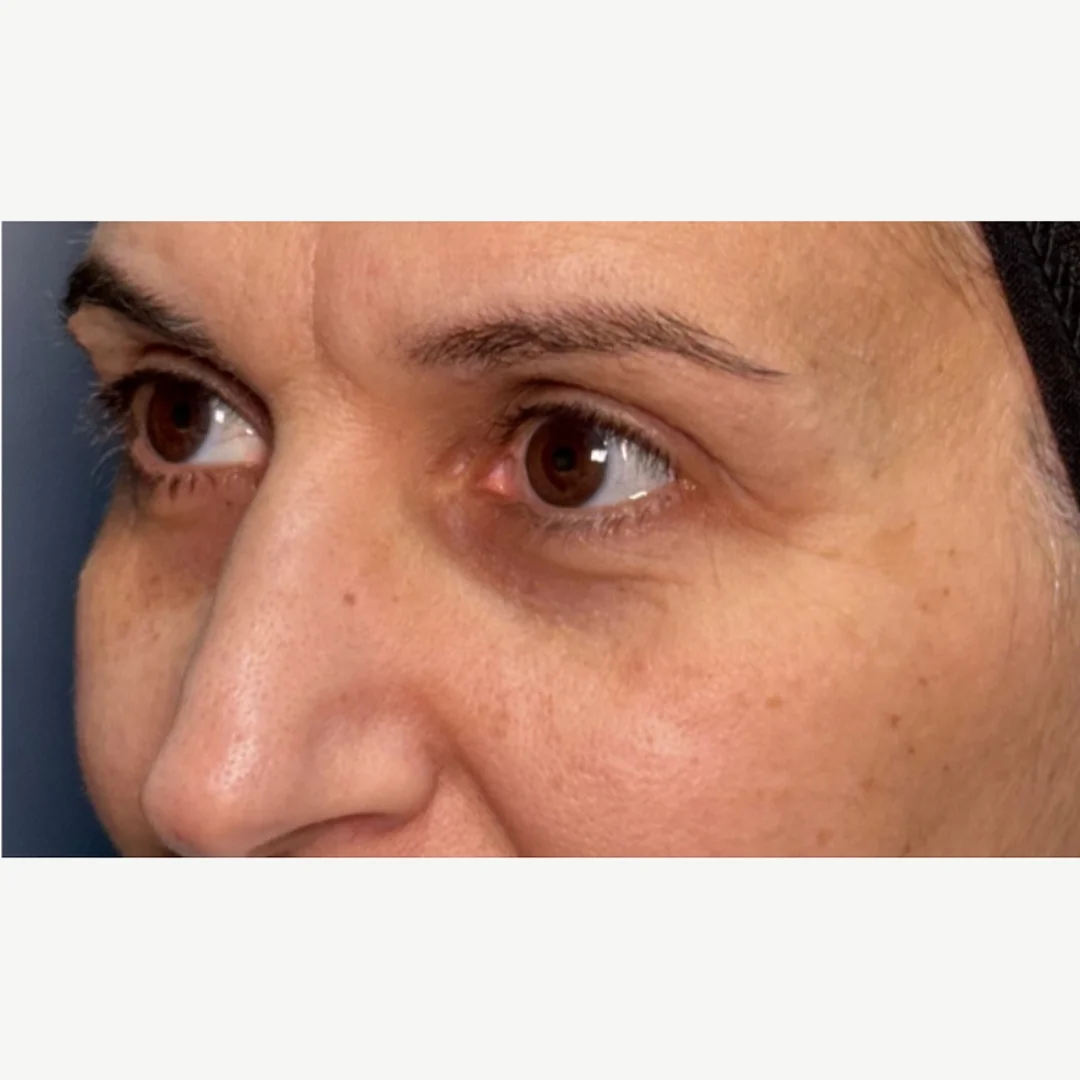 Under-eye before — Morpheus8 Burst under-eye — Rejuvena Clinic Bedford