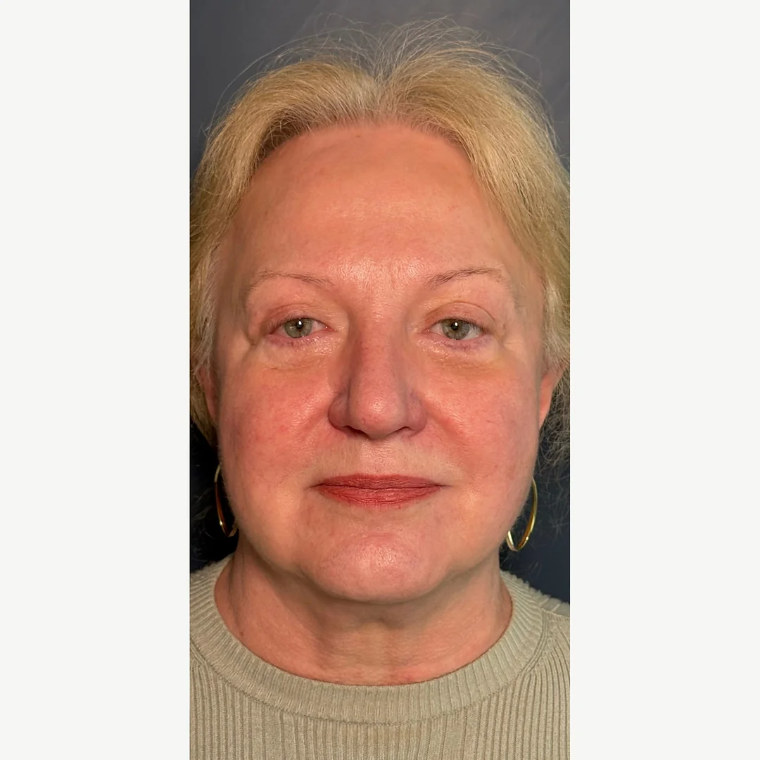 Skin tone after — Morpheus8 Burst resurfacing — Rejuvena Clinic Bedford