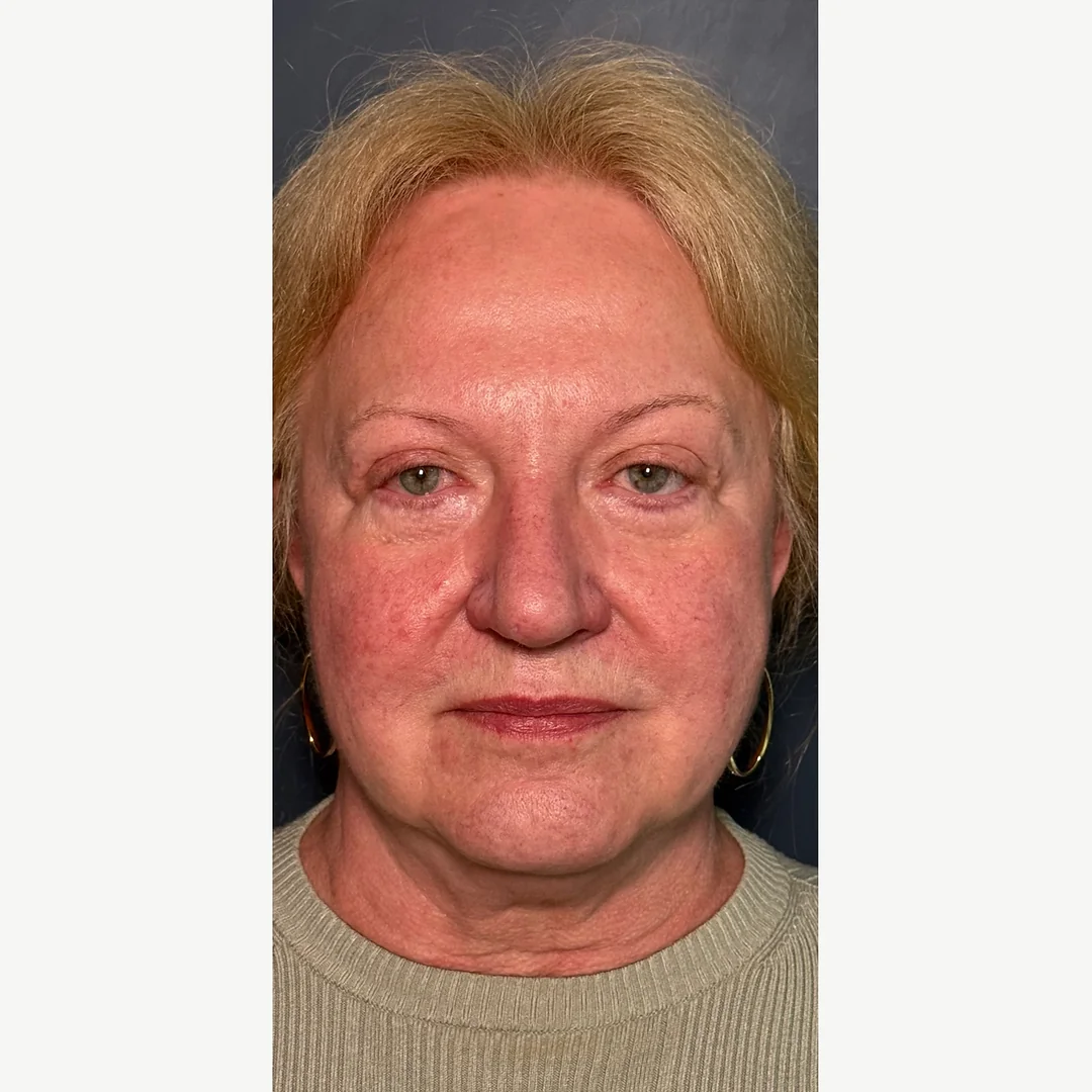 Skin tone before — Morpheus8 Burst resurfacing — Rejuvena Clinic Bedford