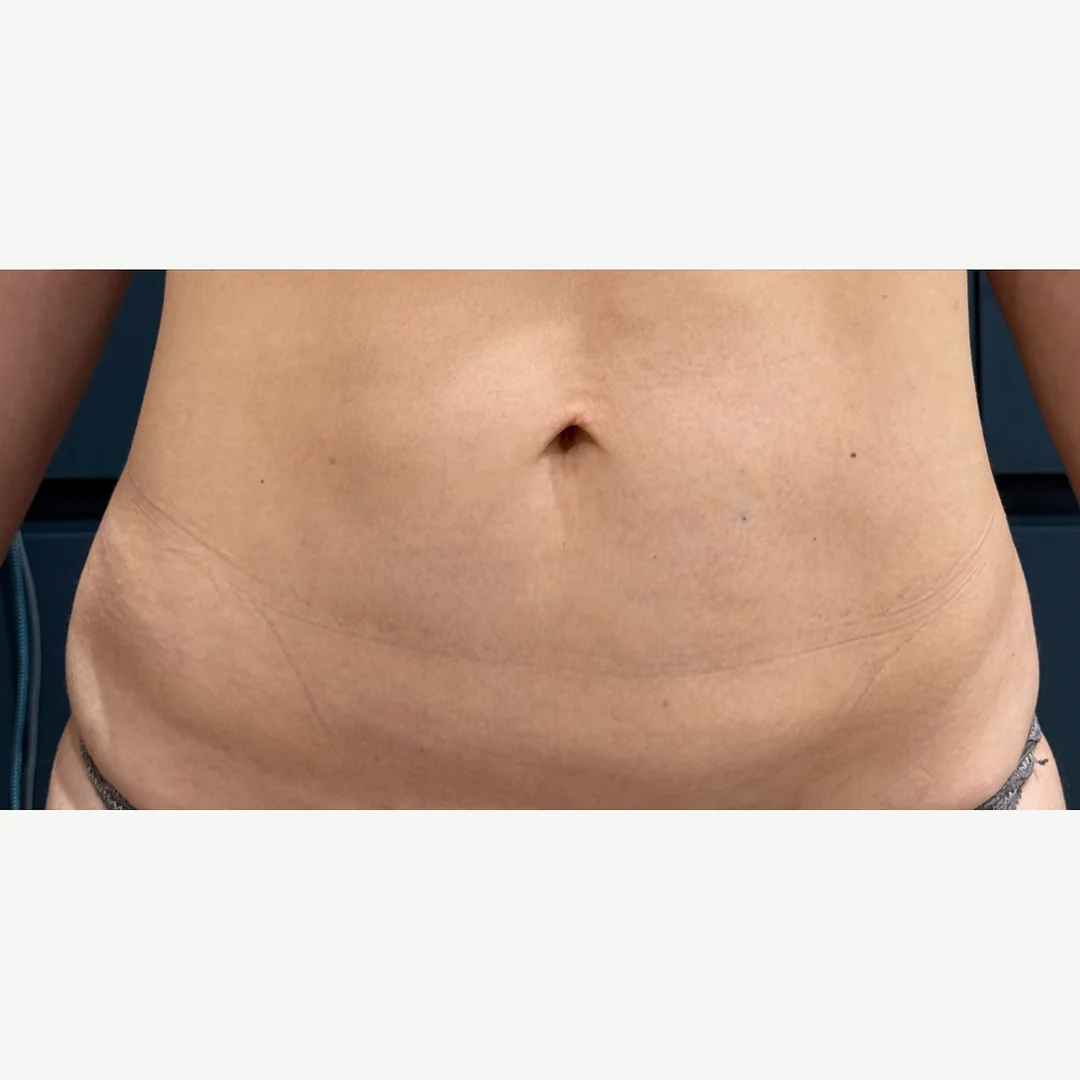 Abdomen after — Morpheus8 Burst skin tightening — Rejuvena Clinic Bedford