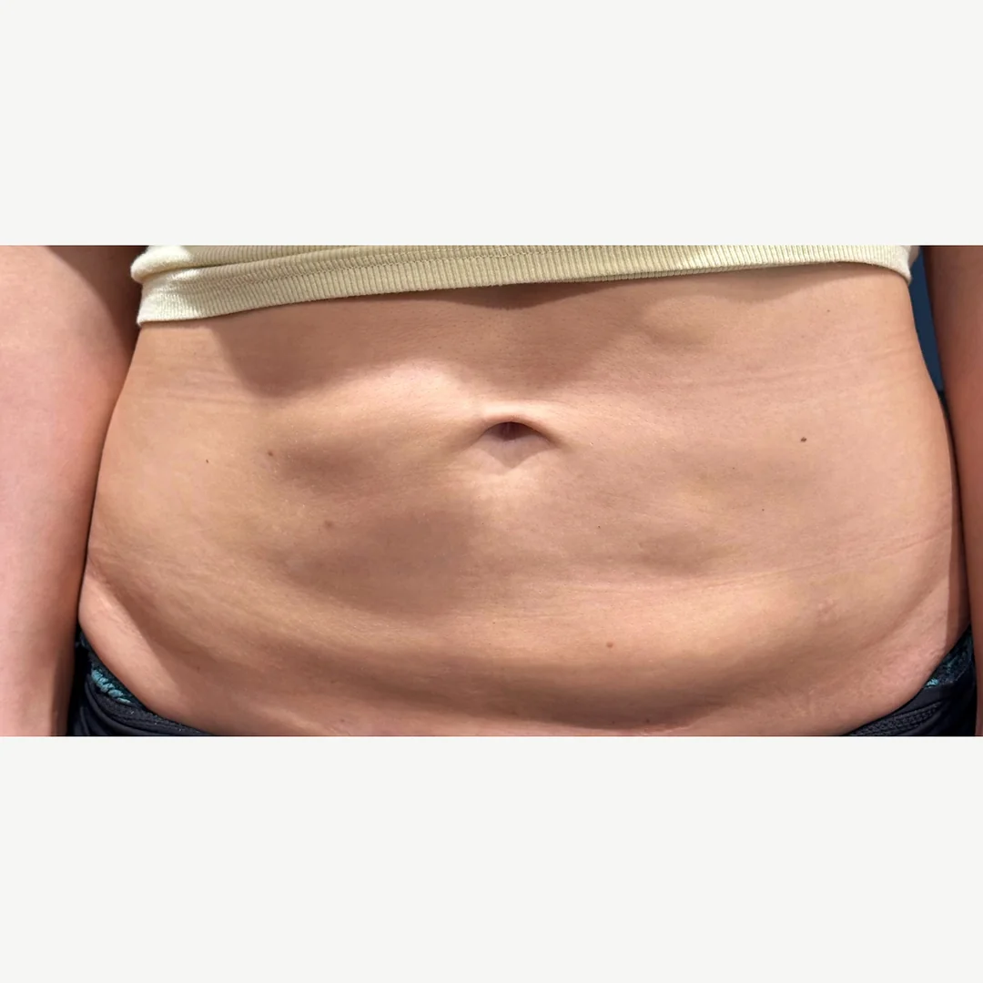 Abdomen before — Morpheus8 Burst skin tightening — Rejuvena Clinic Bedford